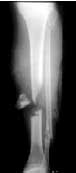 рентгеновский снимок нижней конечности человека